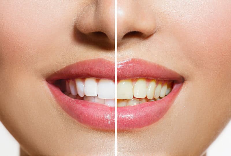 https://www.miskdent.com/wp-content/uploads/2024/04/Teeth-Bleaching-1.jpg