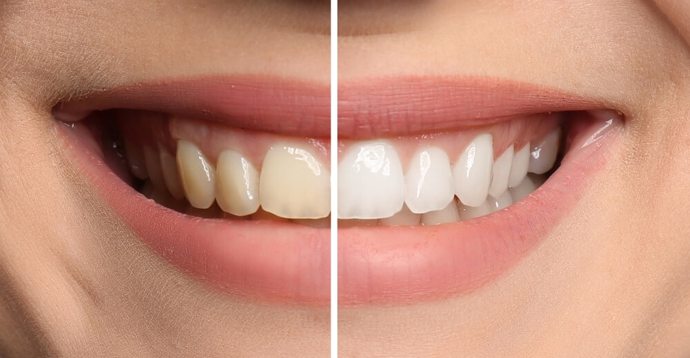 https://www.miskdent.com/wp-content/uploads/2024/04/Teeth-white-1.jpeg